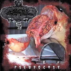 Pseudocyst